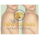 New Canvas Tattoo Removal company logo